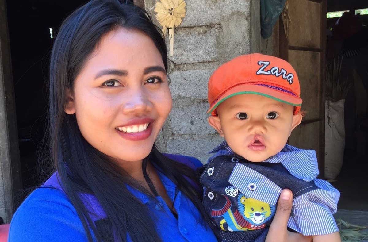 Anak dengan bibir  sumbing Stichting Kolewa